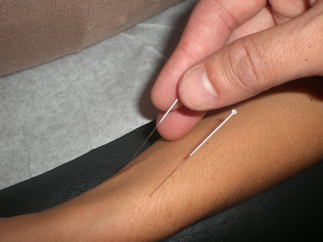Acupuncture Needle Insertion